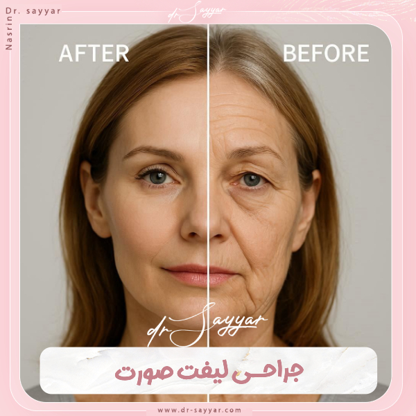 جراحی لیفت صورت - دکتر نسرین سیار