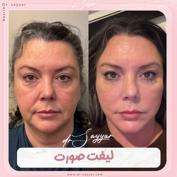 جراحی لیفت صورت - دکتر نسرین سیار
