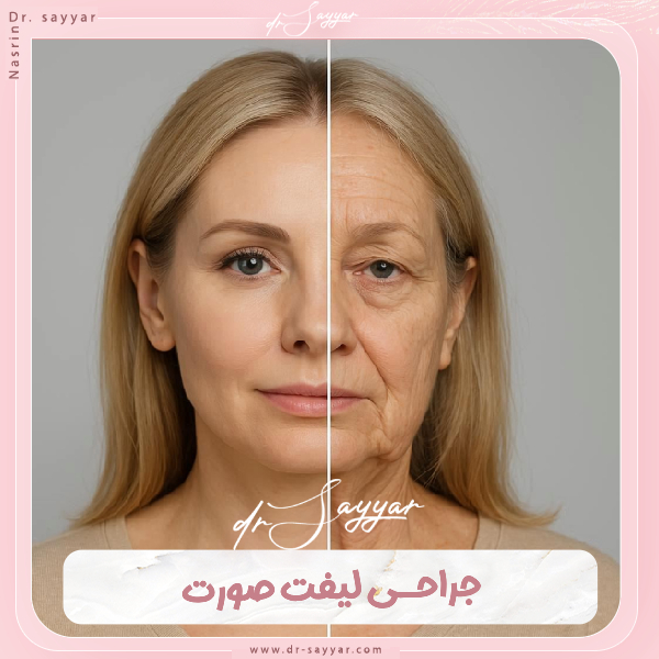جراحی لیفت صورت - دکتر نسرین سیار
