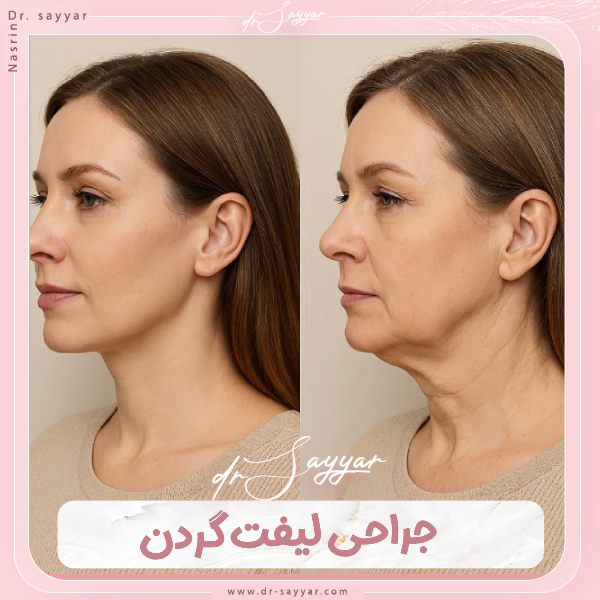 جراحی لیفت گردن - دکتر نسرین سیار