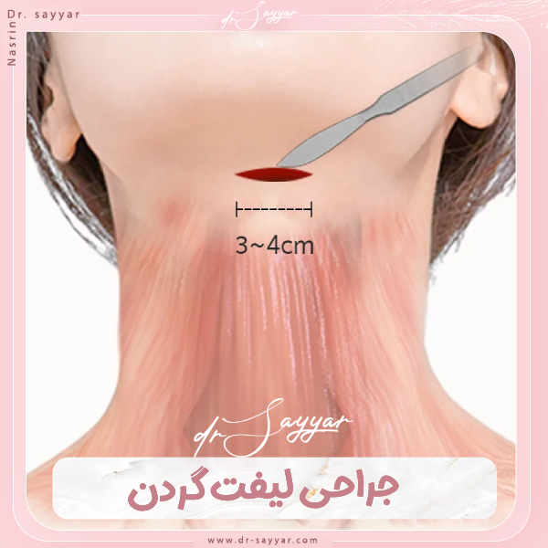 جراحی لیفت گردن - دکتر نسرین سیار
