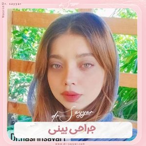 جراحی زیبایی بینی - دکترین نسرین سیار