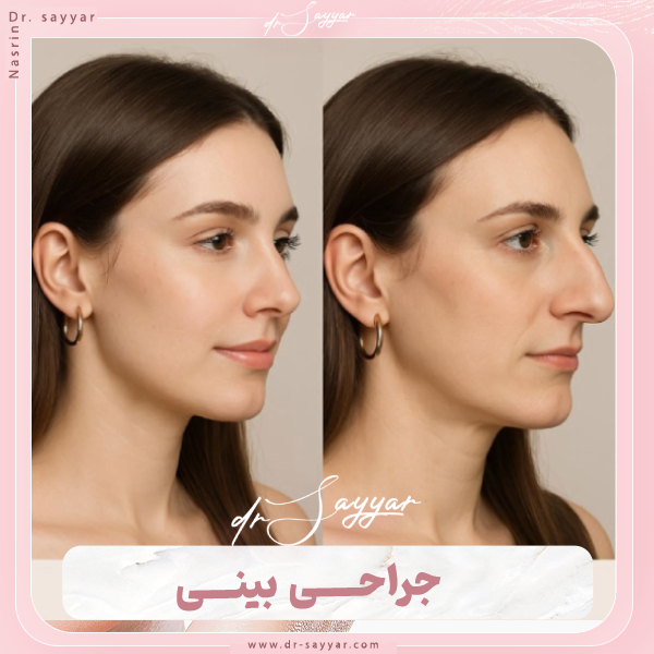 جراحی بینی - دکتر نسرین سیار
