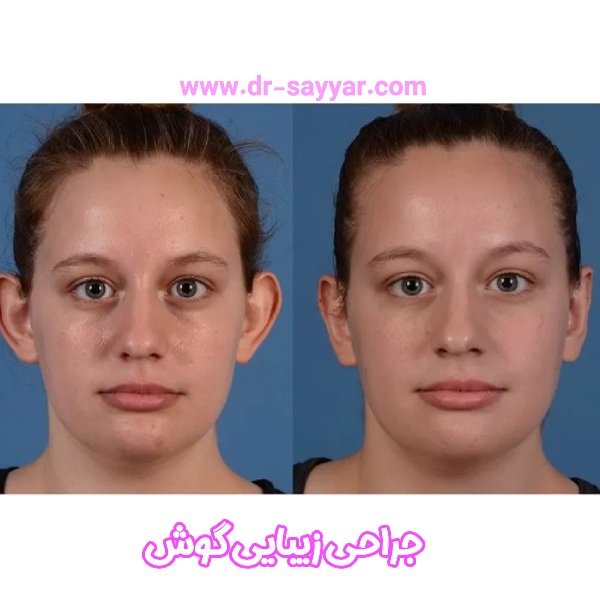 جراحی زیبایی گوش