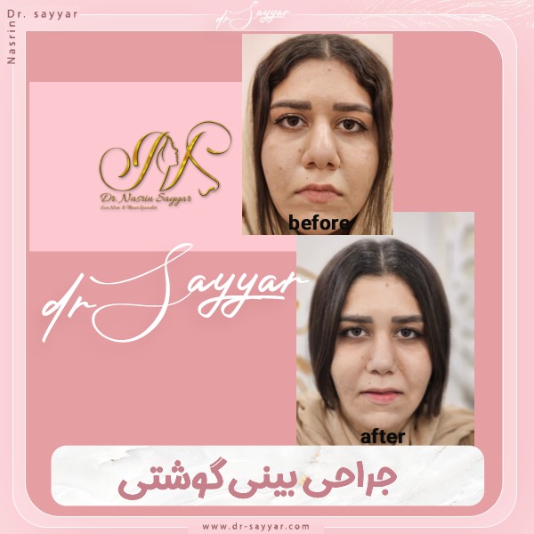 جراحی بینی گوشتی