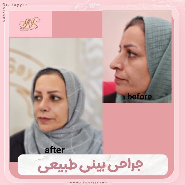 جراحی بینی طبیعی