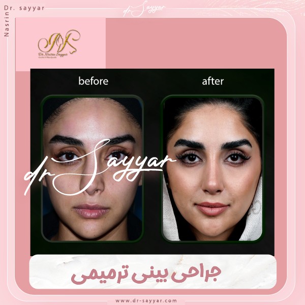 جراحی بینی ترمیمی