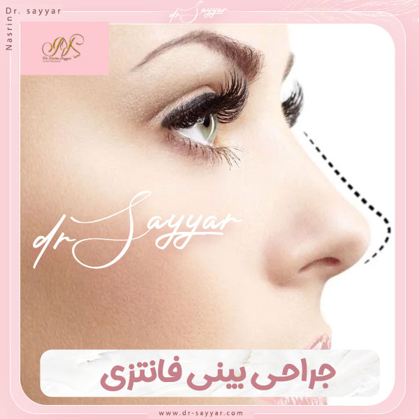 جراحی بینی فانتزی در ساری توسط دکتر سیار