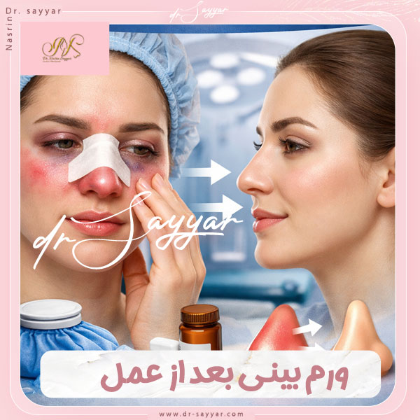 ورم بینی بعد از عمل