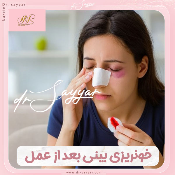 خونریزی بینی بعد از عمل