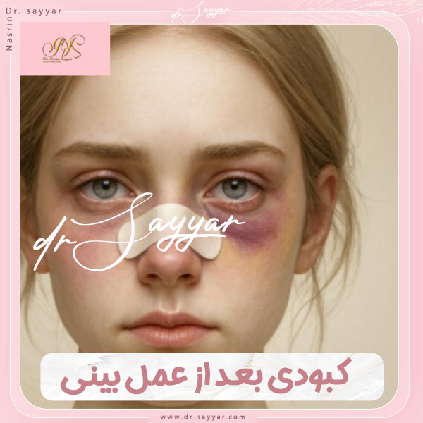 کبودی بعد از عمل بینی