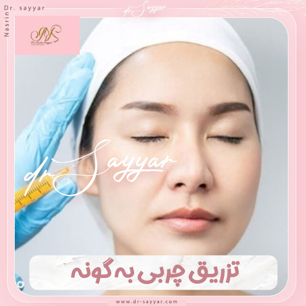 تزریق چربی گونه در ساری توسط دکتر سیار