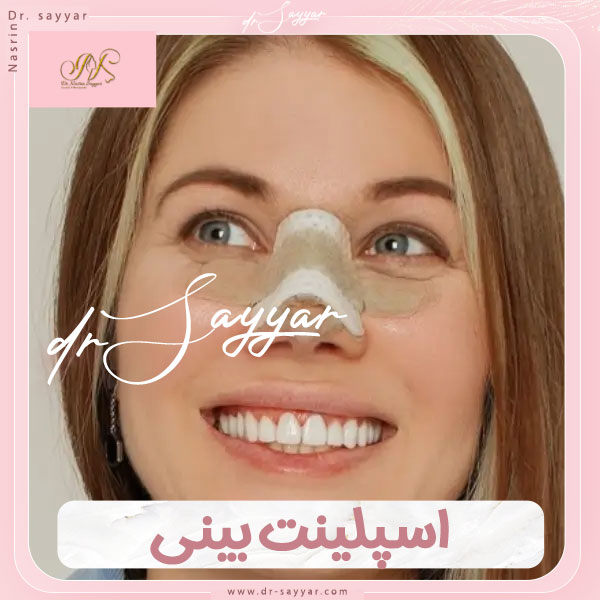 اسپلینت بینی