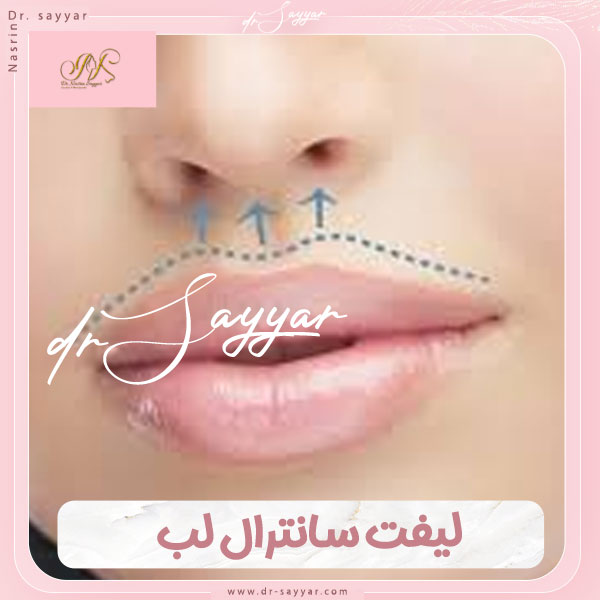 لیفت سانترال لب در ساری توسط دکتر سیار